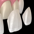 Which is Better: Porcelain or Ceramic Veneers?