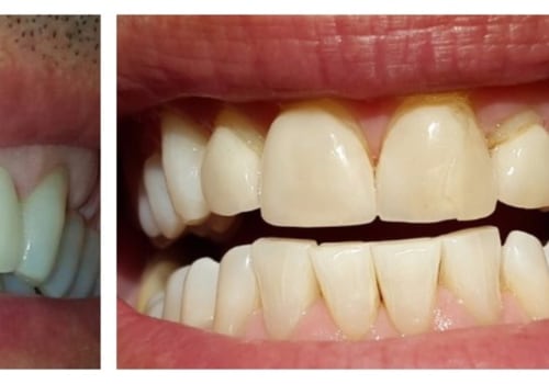 Where to Get Porcelain Veneers for a Perfect Smile